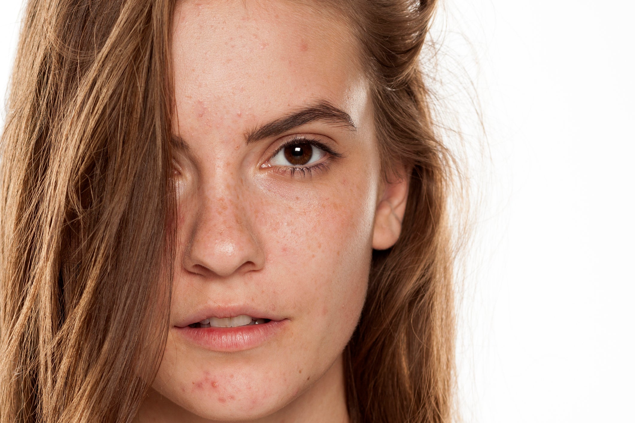 Young female with acne prone skin