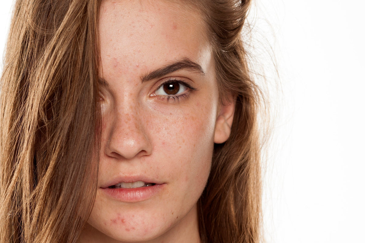 Young female with acne prone skin
